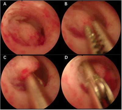 Consistency of P53 immunohistochemical expression between preoperative biopsy and final surgical specimens of endometrial cancer